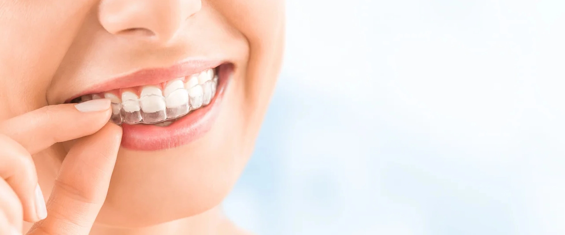 Are You Looking for Invisalign in Vancouver?
