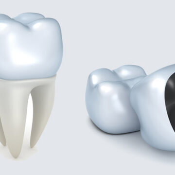 Dental Crowns