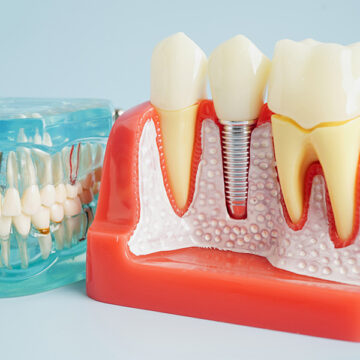Dental Implants Restorations