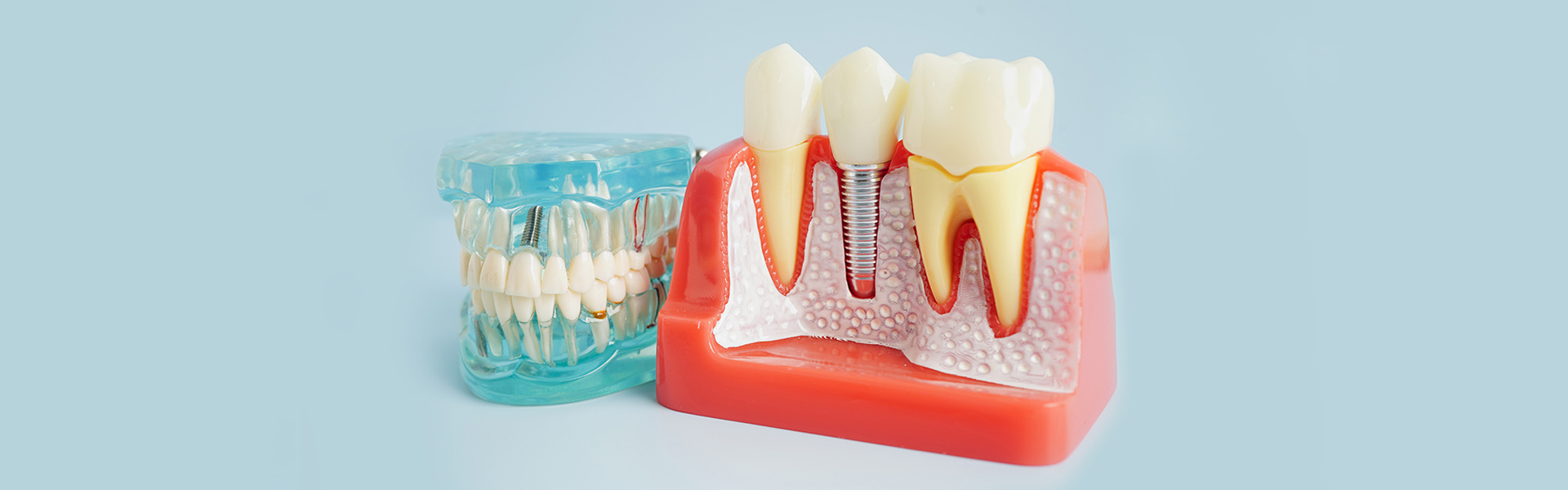 Dental Implants Restorations