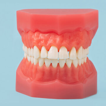 Snap on Dentures