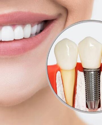 Dental Implants