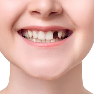 Missing a Tooth? Discover the Benefits of Dental Implants!