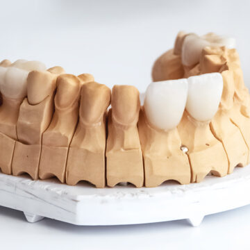 What Are Dental Veneers? A Complete Guide for First-Time Patients